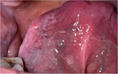 Diagnosis of oral potentially malignant disorders: Overview and experience in Oceania